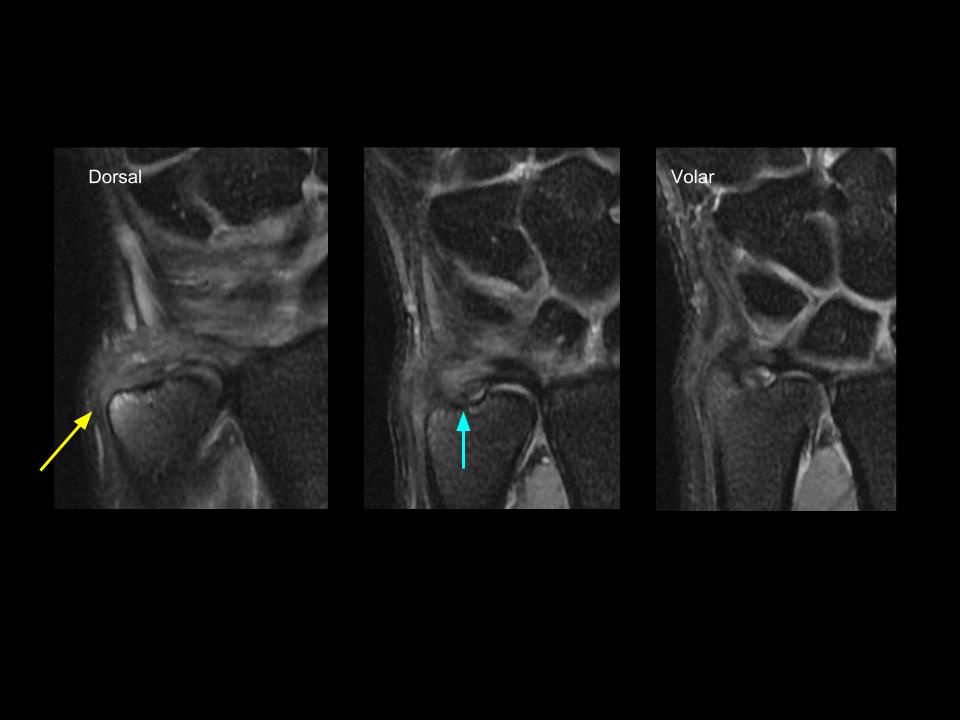 Figure 3 for case extensor carpi ulnaris tendon ( RID2382 )